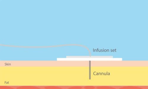 Side-view graphic of an infusion set on the skin's surface with the cannula inserted into the skin & fat layers