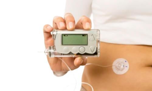Close-up of woman wearing an infusion set near her belly & holding up the insulin pump