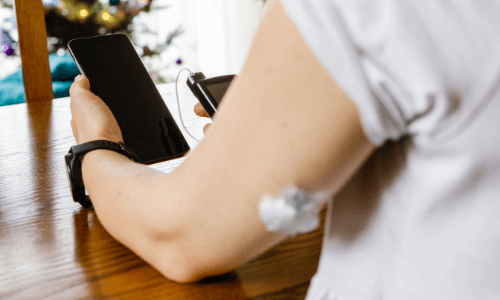 Close-up of infusion set on female upper arm while she holds a smartphone in one hand & an insulin pump in the other