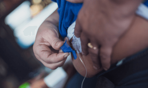 Close-up of adult attaching insulin pump cannula to the abdomen